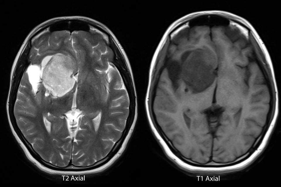 Research by Keele alumnus improves outcomes for children with rare type of brain tumour