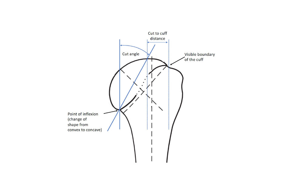 Current shoulder osteotomy angle does not produce a circular osteotomy