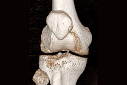 Regenerative medicine: knee